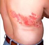 SHINGLES INCREASE RISK FOR STROKE – INTEGRATIVE APPROACH